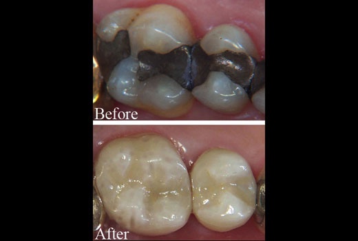 Cerec One Appointment Crowns