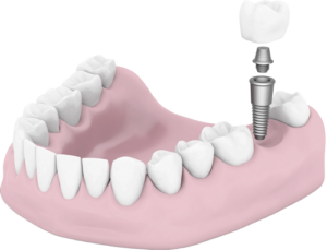 Dean Dental Implant