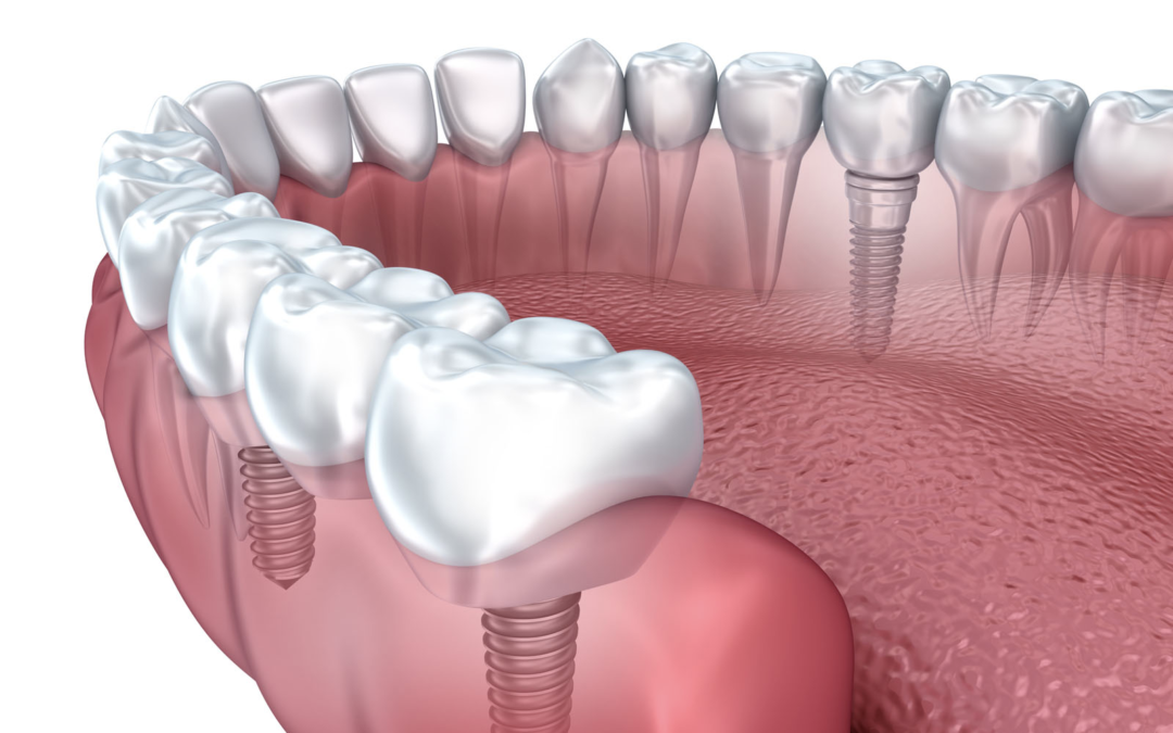 Incredible advantages of dental implants and why they are so popular