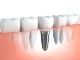 Dental Implant benefits