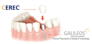 Dental Implants @ Dean Cosmetic Dentistry