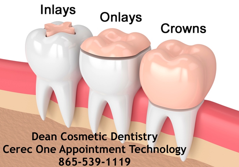 Dean Cosmetic Dentistry Offers One Appointment Dental Crowns