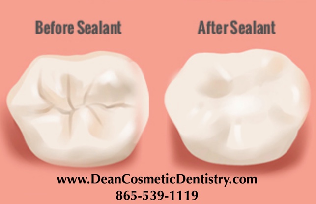 Do Dental Sealants Really Work