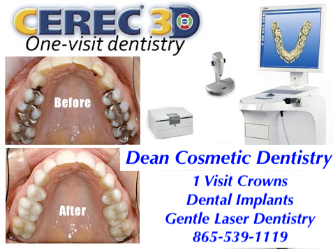 Dean Cosmetic Dentistry 1 Visit Dental Crowns