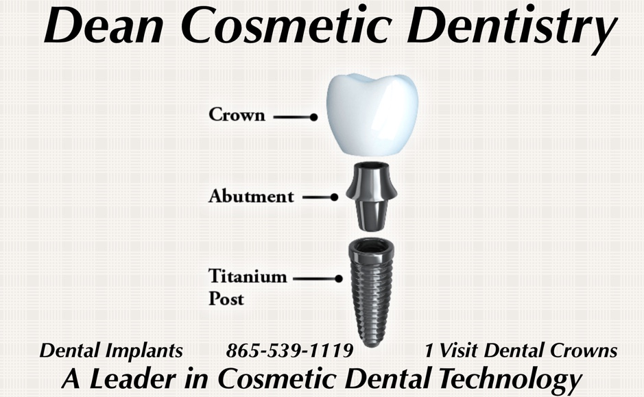Dental Implants Dean Cosmetic Dentistry