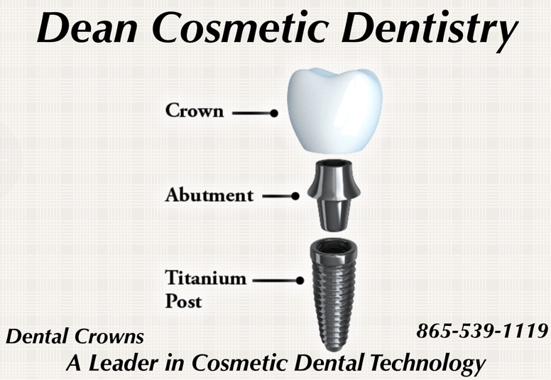 Dental Implants @ Dean Cosmetic Dentistry