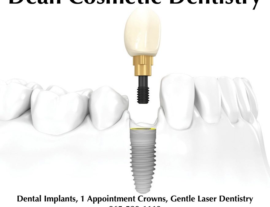 Improve your quality of life with dental implants